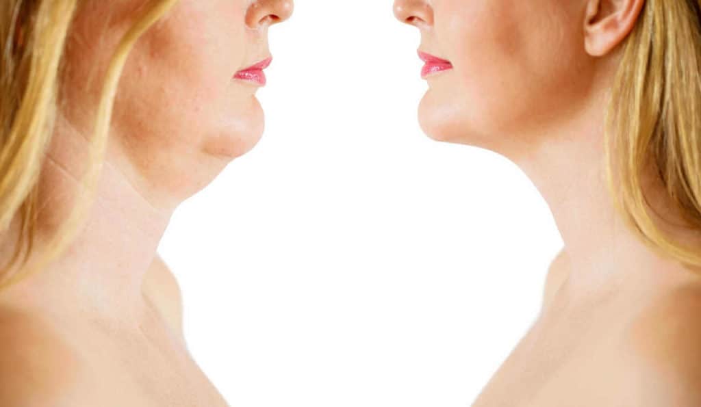 Double Chin treatment Hertfordshire before and after results