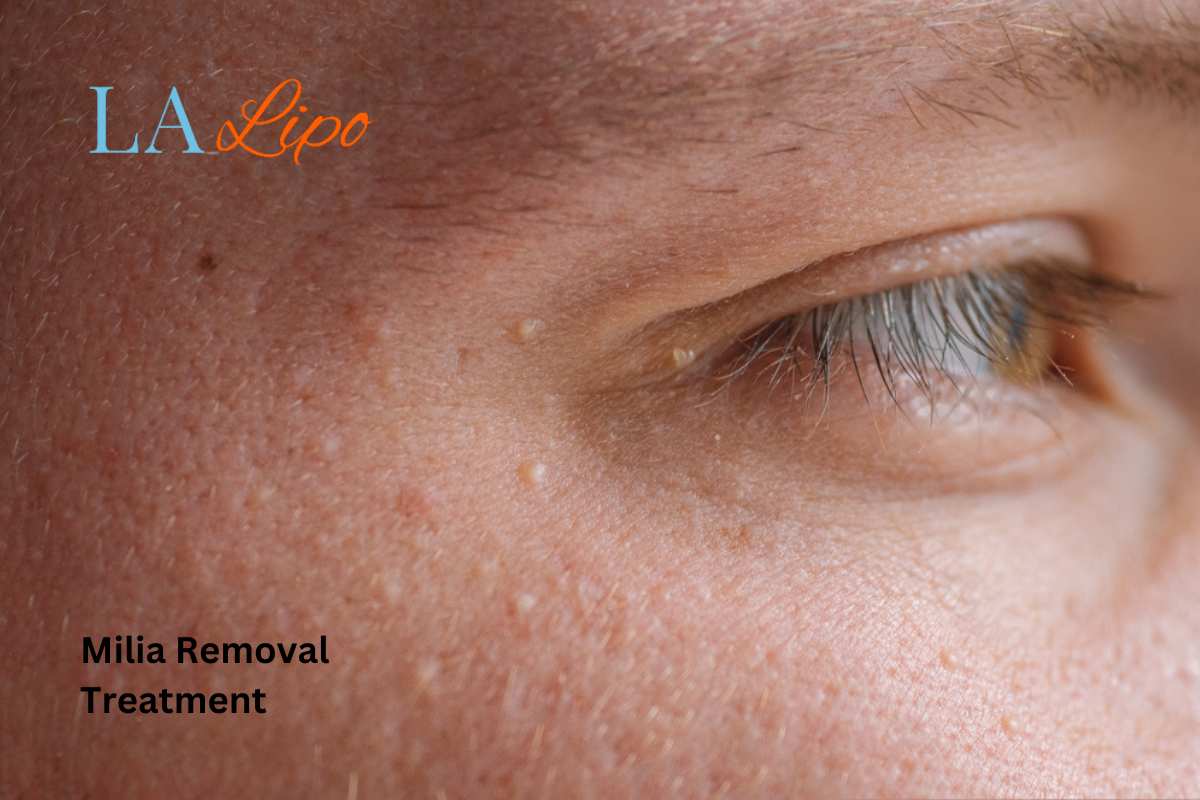 Cryopen Milia Removal: Is It the Easiest and Safest Option Hertfordshire?