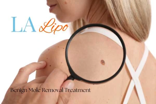 Why getting moles removed Hertfordshire can boost your confidence!