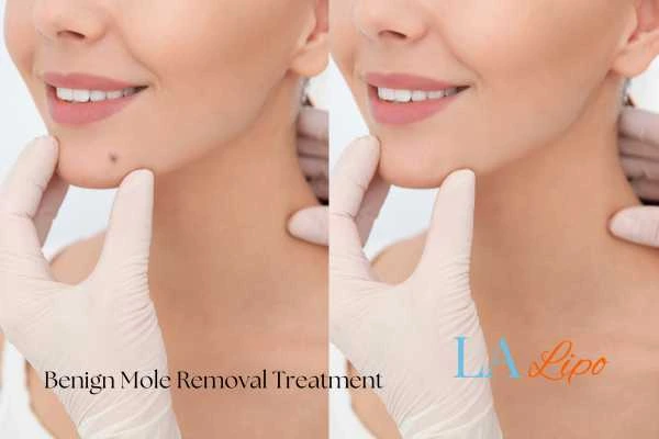 Woman's before and after results of being moles removal treatment Hertfordshire