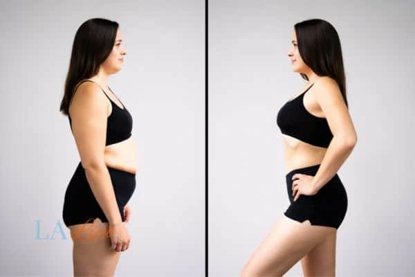 image of woman before and after results of LA-EMS Body Sculpting Hertfordshire to help treat Diastasis recti