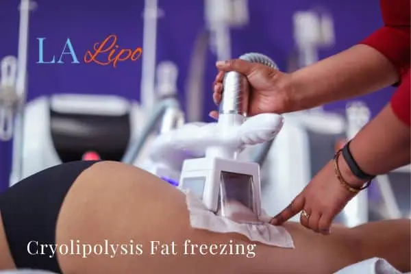 women getting fat freezing Hertfordshire