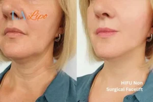 hi-fu for wrinkles Hertfordshire before and after results