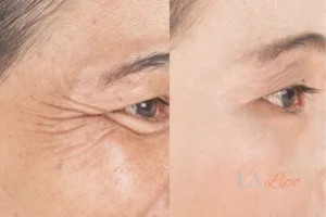 Before and after results of woman - HI-fu wrinkles reduction treatment Hertfordshire