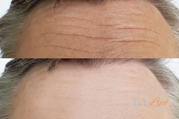 results of HIFU Hertfordshire on mans forehead to help reduce lines and wrinkles