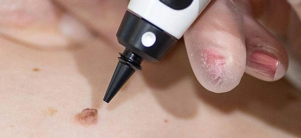 skin tag removal using cryopen Hertfordshire