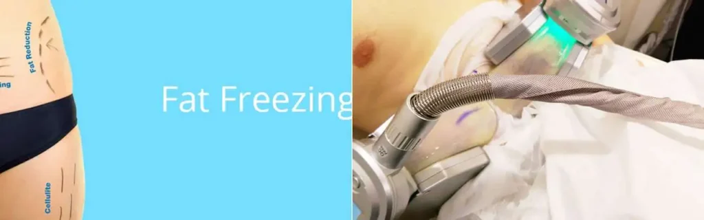 Fat freezing Hertfordshire on multiple areas of the body