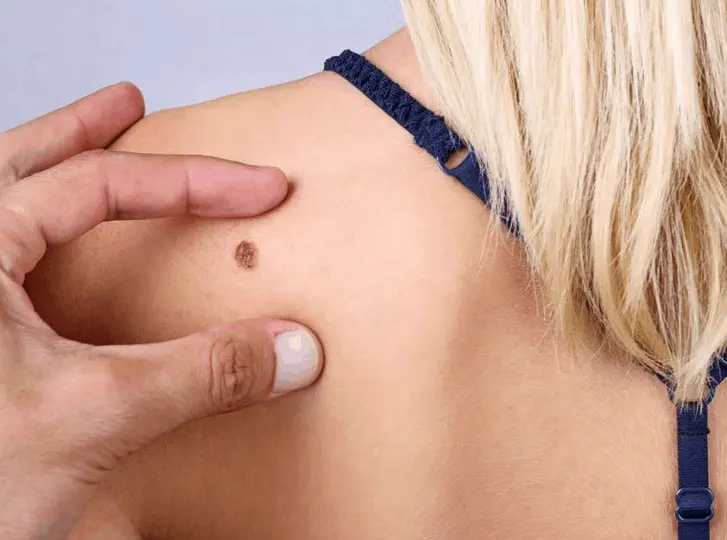 woman having mole removal Hertfordshire consultation before treatment.