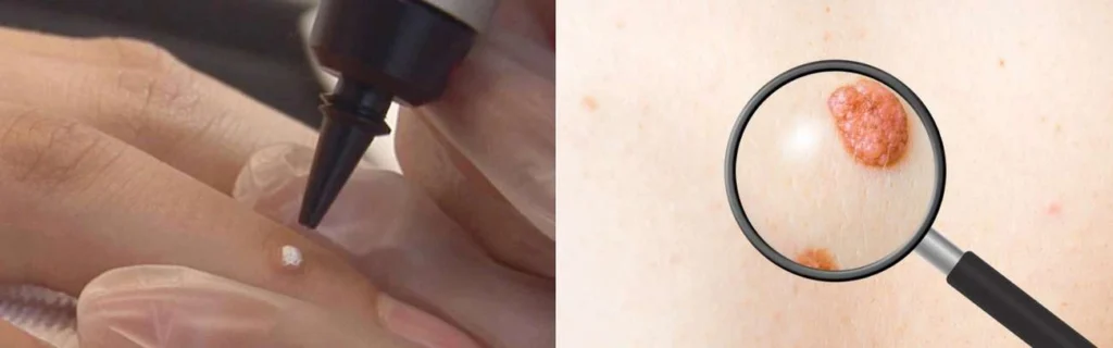Person getting moles removed with cryopen Hertfordshire