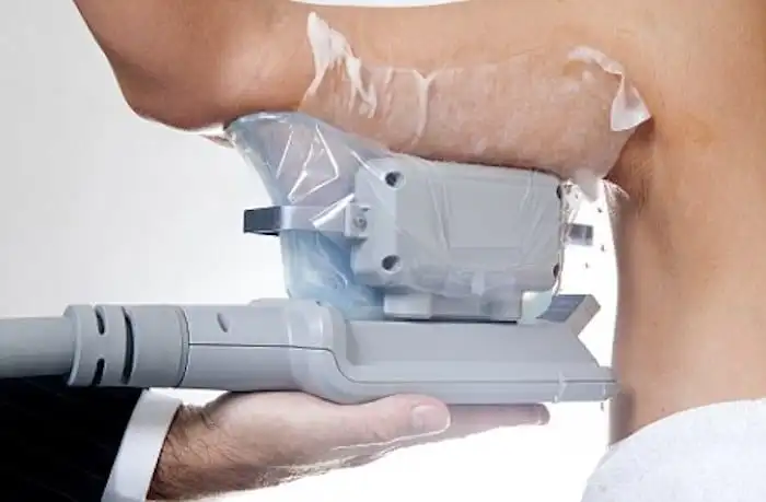 Picture of fat freezing Hertfordshire on the upper arms.