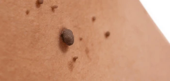 image of a skin tag Hertfordshire