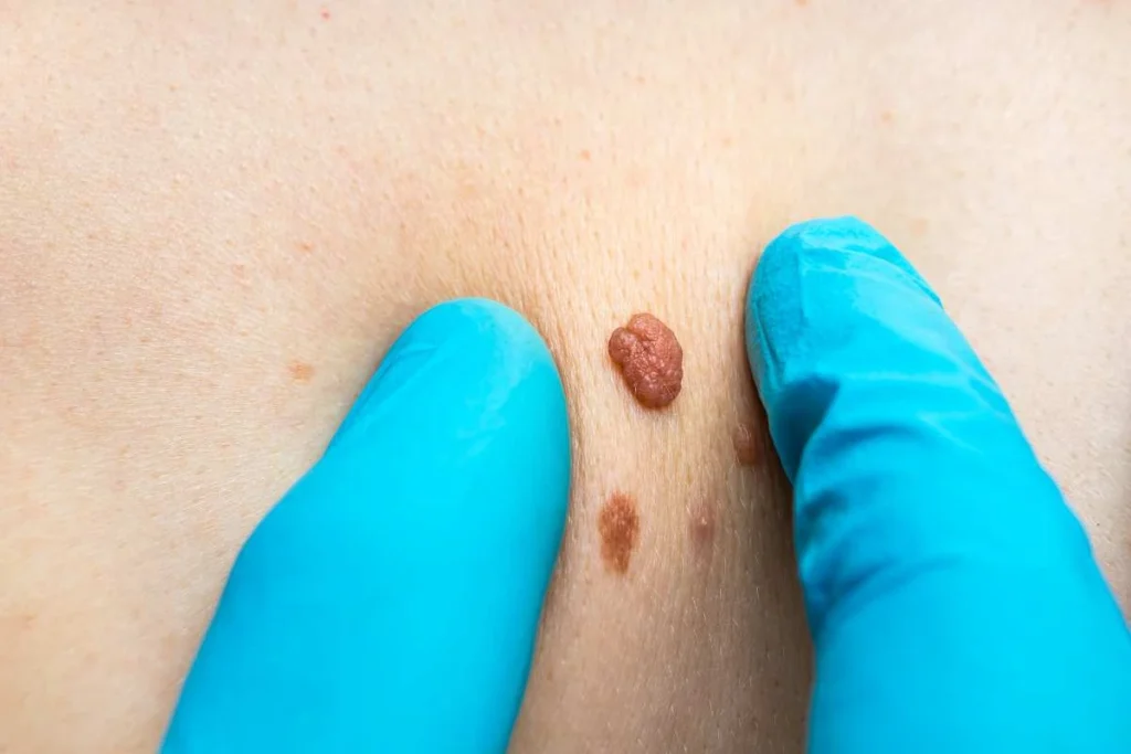 Consultant examining a skin tag Hertfordshire