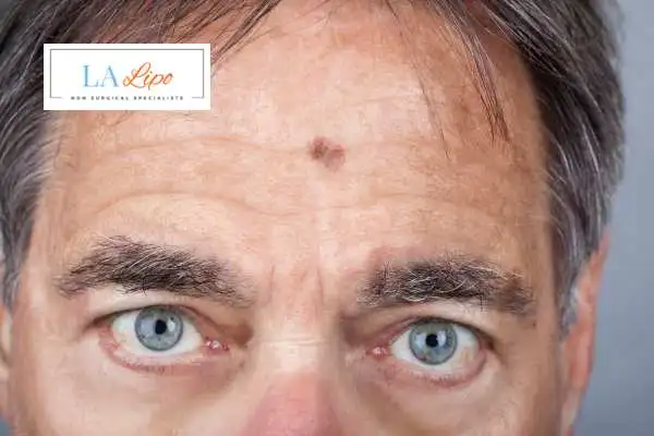 Solar Lentigo Removal Hertfordshire image of man with mark on his forehead
