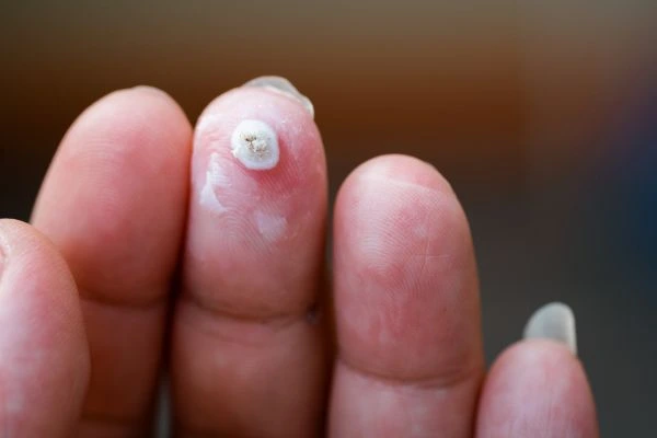 wart on person finger - cryotherapy to treat from LA LIPO Hertfordshire