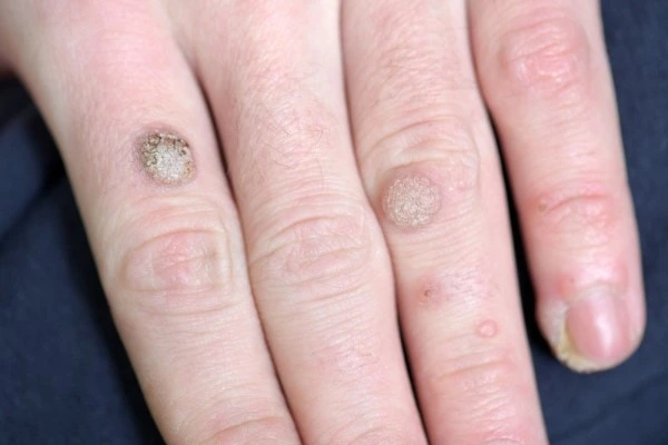 photo of warts on person hand - see wart removal Hertfordshire from LA LIPO