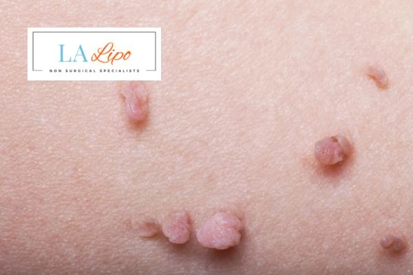 Does cryopen skin tag removal Hertfordshire hurt? Find out now call our team today!