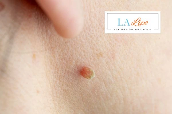 Book skin tag removal Hertfordshire today speak to our team now!