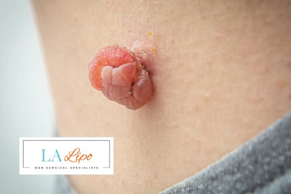 Interested in skin tag removal Hertfordshire? Concerned about the pain? Find out more today!