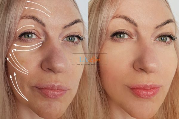 Morpheus 8 results Hertfordshire face lift.