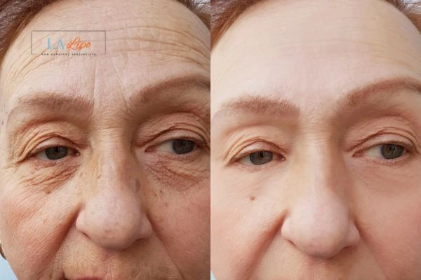 The powerful benefits of Morpheus8 Treatment Hertfordshire - Call Our team today!