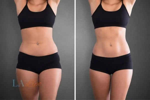 before and after results of non-surgical treatment to help a woman's body image and mental health Hertfordshire