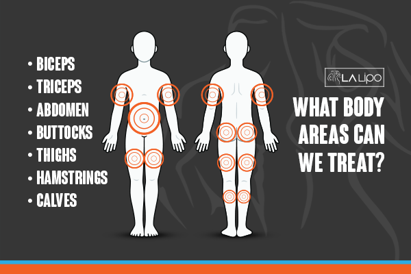 Diagram to show areas you can have LA-EMS Body Sculpting Treatment Hertfordshire