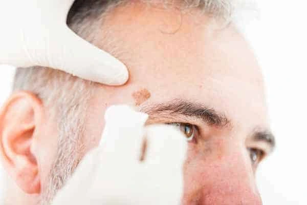 Age spots and elderly people Hertfordshire what is the link?