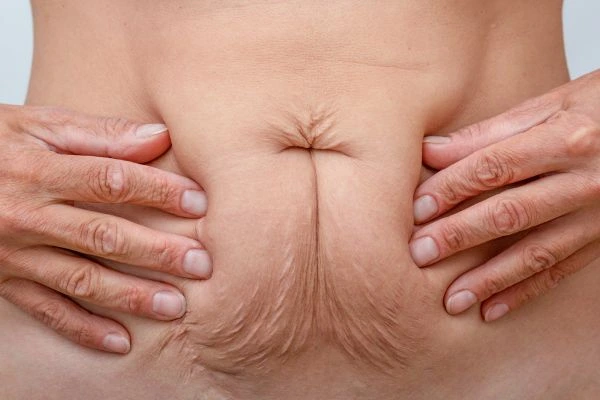 Image of a woman's stomach with loose skin - example of skin tightening Hertfordshire options