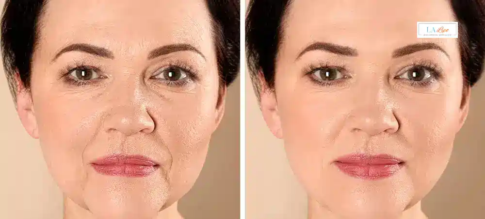 How Long Does It Take to See Results and How Long Do They Last Hertfordshire?